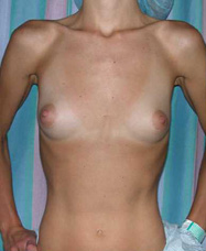 Patient # 48440 Before Photo # 1